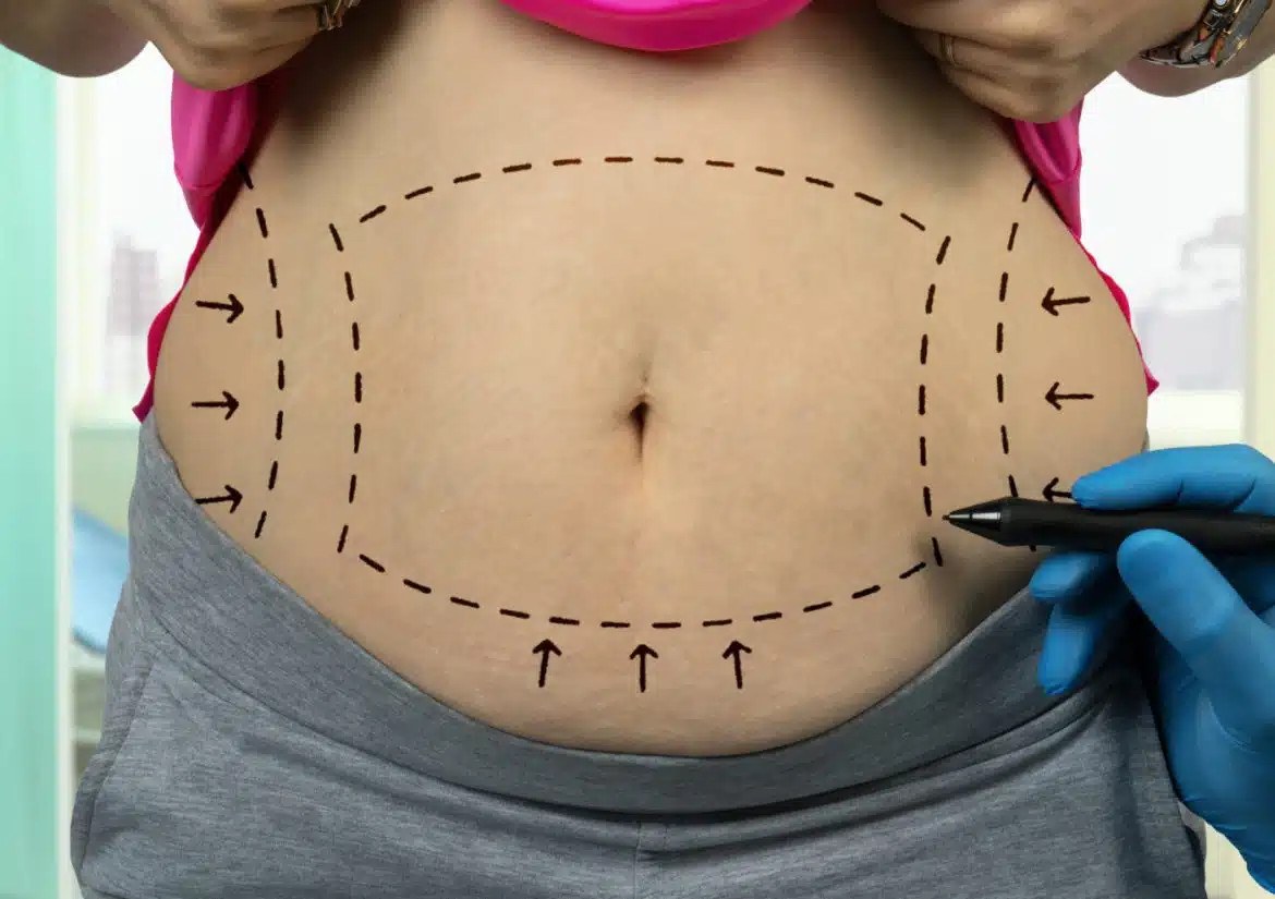 Abdominoplastie