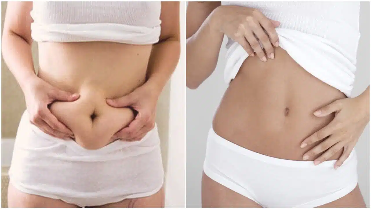 Abdominoplastie