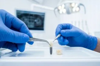 sourire avec implants dentaires