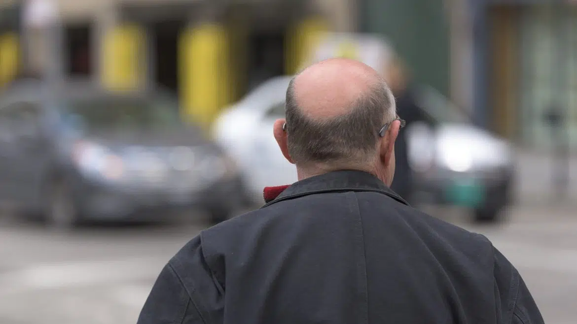 Quelle solution contre la perte des cheveux ?